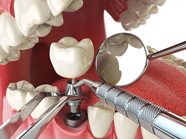 Best Emergency Root Canal Treatment in Oakdale, MN